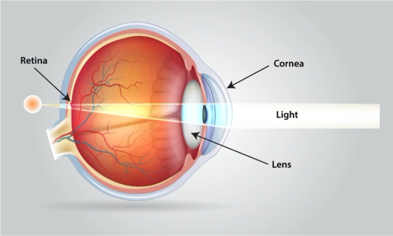 Kondisi Mata yang Dapat Ditangani Dengan Tindakan LASIK